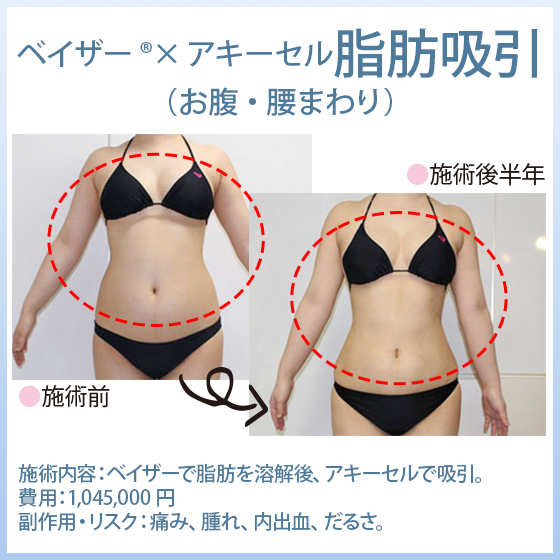 「ベイザー®脂肪吸引×アキーセル脂肪吸引」 お腹・腰まわりの脂肪吸引